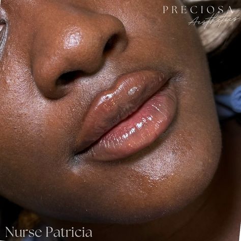 Look at that cupids bow 😍 Gorgeous lips using just 0.5ml of lip filler 💉✨ Book your appointment today 🤍 📱 647-984-8802 🖥️ www.PreciosaAesthetics.com 📧 Preciosa.Aesthetics@hotmail.com 📍 102 Lakeshore Road East, Mississauga #BeautyTransformation #SnatchedLook #DermalFillers #FacialEnhancement #JawlineGoals #GlowUp #ConfidenceBoost #lipfiller #chinfiller #cheekfiller #AestheticMedicine #filler #lips #beauty #aesthetics #botox #dysport #nucieva #mississauga #portcredit #toronto #oakville #nurs... Overfilled Lips, 0.5 Ml Lip Filler Before And After, Lip Filler Before And After, Lip Filler Aesthetic, Jawline Goals, Abdominal Stretches, Aesthetic Treatments, Chin Filler, Cheek Fillers