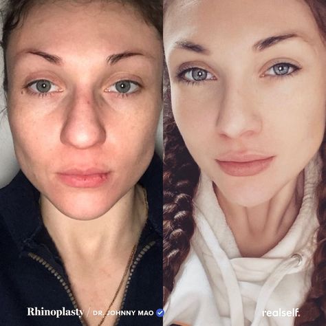 Rhinoplasty Swelling Progression, Bulbous Nose Rhinoplasty Before After, Rhinoplasty Recovery Timeline, Nose Job Before And After, Bulbous Nose Rhinoplasty, Nose Job Recovery, Swelling Remedies, Nose Plastic Surgery, Rhinoplasty Recovery