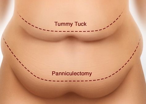 Loose Skin Surgery, Tummy Tucks Recovery, Skin Removal Surgery, Mommy Makeover Surgery, Bariatric Sleeve, Mommy Tummy, Excess Skin, Mommy Makeover, Tummy Tucks