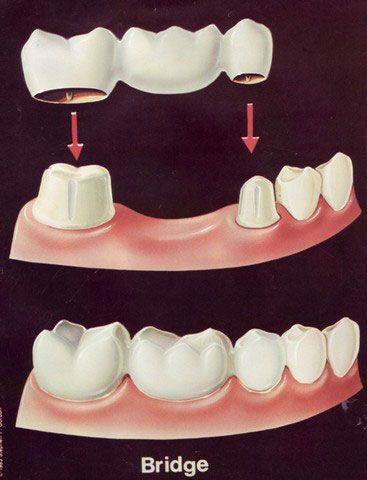 Removable Partial Denture, Tooth Bridge, Dental Assistant Study, Ceramic Braces, Dental Caps, Dental Smile, Tooth Crown, Dental Posters, Partial Dentures