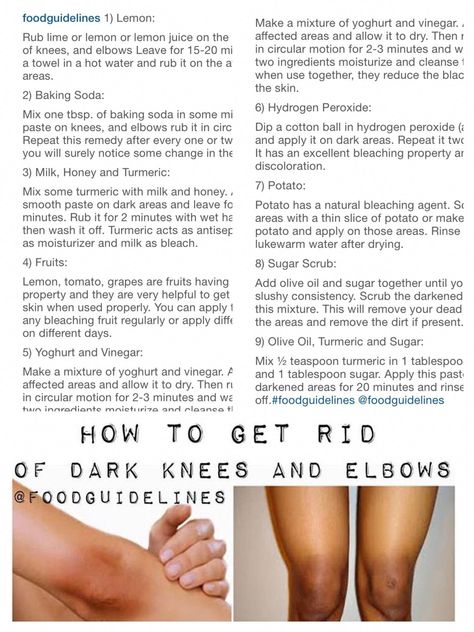 Dark Knees And Elbows Remedies, Dark Knees And Elbows, Leg Scars, Healthy Self Care, High School Prep, Dark Knees, Getting Rid Of Scars, Dark Elbows, Skin Clearing