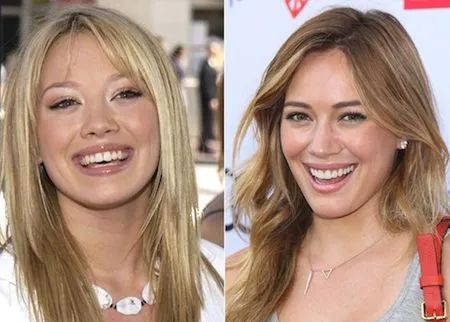 5 Celebrities You Didn’t Know Had Veneers - West Palm Beach Dentist Celebrity Veneers, Celebrities With Veneers, Hollywood Smile Veneers, Cosmetic Dentistry Procedures, Smile Makeover, Stars Then And Now, Hilary Duff, West Palm Beach, West Palm