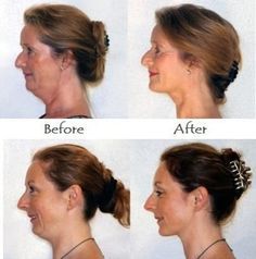 Tone double chin and get a defined jawline with face aerobics workouts. Use toning exercises to lose turkey neck and double chin without needing surgery procedures Saggy Cheeks, Defined Jawline, Face Lift Exercises, Beachbody Workout, Double Chin Removal, Double Chin Exercises, Toning Exercises, Chin Exercises, Face Fat