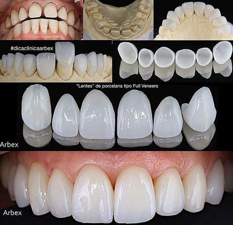 Pin de Vivré en Study | Carillas dentales, Arte dental, Estetica dental Teeth Makeover, Dental Wallpaper, Dental Images, Tooth Repair, Dental Aesthetics, Dental Videos, Dental Photography, Windows To The Soul, Veneers Teeth