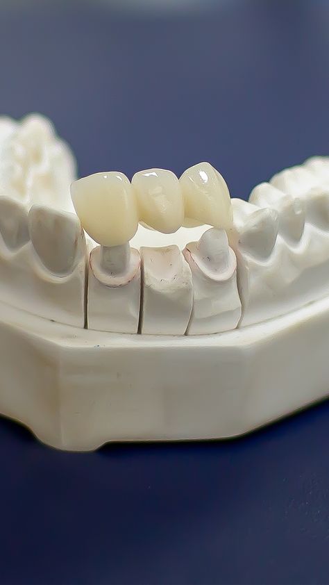 A dental bridge can be placed on prepared teeth and implants and are a great option to replace or repair missing or broken teeth.
.
😁 Transform Your Smile
💶 Bridges €400-€500 Per Tooth
👨🏻‍⚕️ Free Consultation
💶 €50 Refundable Booking Deposit
💳 Payment Plans Available Tooth Surfaces Dental, Abcessed Tooth, Tooth Bridge, Dentist Ideas, Dentist Branding, Dental Retainer, Dental Photos, Dental Images, Dental Implant Procedure