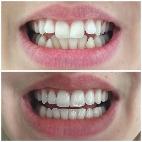 What a beautiful transformation 😃💜 #smilemakeover Sensitive Teeth Remedy, Dental Videos, Kesehatan Gigi, Heal Cavities, Veneers Teeth, Dental Art, Botox Injections, Best Teeth Whitening, Dental Surgery