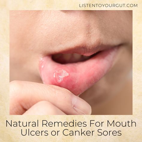 Blister In Mouth, Gum Sores, Ulcer Remedies Mouth, Canker Sore Remedy, Tongue Sores, Fever Blister, Canker Sore, Tongue Health, Cold Sore