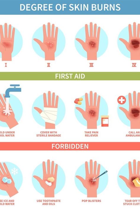 First Aid Poster, First Aid For Burns, Burn Remedy, Survival Skills Emergency Preparedness, Treat Burns, Medical Tips, First Aid Tips, Basic First Aid, Babysitting Jobs