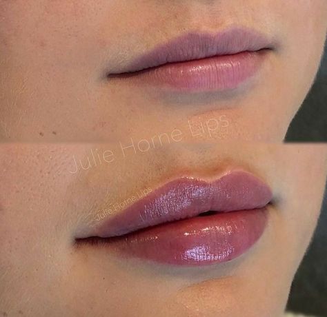 Filler Transformation, Lip Permanent Makeup, Lips Inspiration, Botox Lips, Facial Fillers, Lip Augmentation, Facial Aesthetics, Cosmetic Dermatology, Lip Filler