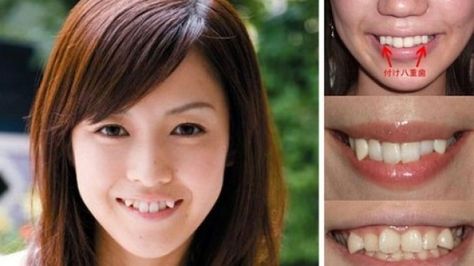 Cute? The snaggletooth trend has been growing in Japan. Imperfect Teeth, Snaggle Tooth, Teeth Aesthetic, Teeth Drawing, Smile Drawing, Crooked Teeth, Dental Tourism, Cute Tooth, Teeth Braces