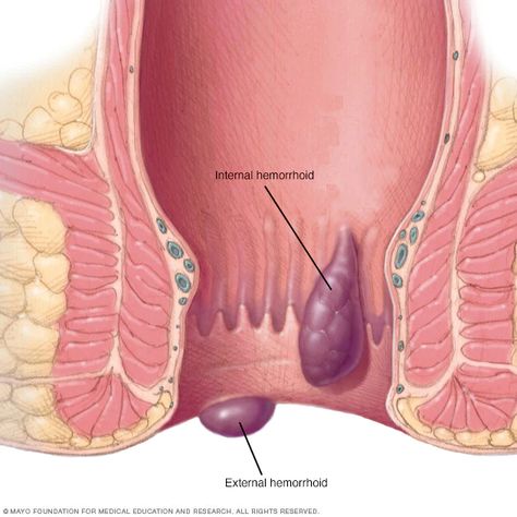 Hemorrhoid Remedies, Hemorrhoid Relief, Natural Treatments, Back Pain, Home Remedies, Natural Remedies, Anatomy