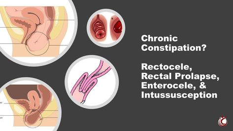 Valsalva Maneuver, Rectal Prolapse, Pelvic Organ Prolapse, Chronic Cough, Chronic Constipation, Ehlers Danlos, Normal Body, Ehlers Danlos Syndrome, Muscle Tissue