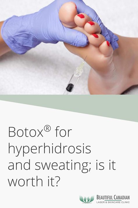 Botox® For Hyperhidrosis & Sweating; Is It Worth It? Botox For Sweating, Botox Injections, Is It Worth It, Cosmetic Procedures, Worth It, Vancouver, Quick Saves, Beauty