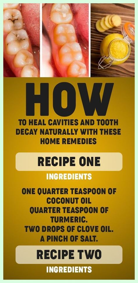 Heal Cavities, Teeth Health, Receding Gums, Home Health Remedies, Cold Home Remedies, Oral Health Care, Natural Health Remedies, Tooth Decay, Healthy Teeth