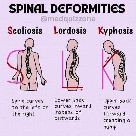 🚨 Understanding Spinal Deformities: ✍🏻A Quick Overview🩺 Spinal deformities can affect posture, movement, and overall health. Here’s a simple breakdown of the three main types: 1️⃣ Scoliosis: The spine curves to the left or right, creating an “S” or “C” shape. This sideways curvature can cause uneven shoulders, hips, and other postural issues. 2️⃣ Lordosis: The lower back curves inward excessively, leading to a pronounced arch in the lower spine. This condition, also known as swayback, can... Uneven Shoulders, Lumbar Spine, Concept Board, Overall Health, Left Or Right, Lower Back, Medicine, Arch, Health