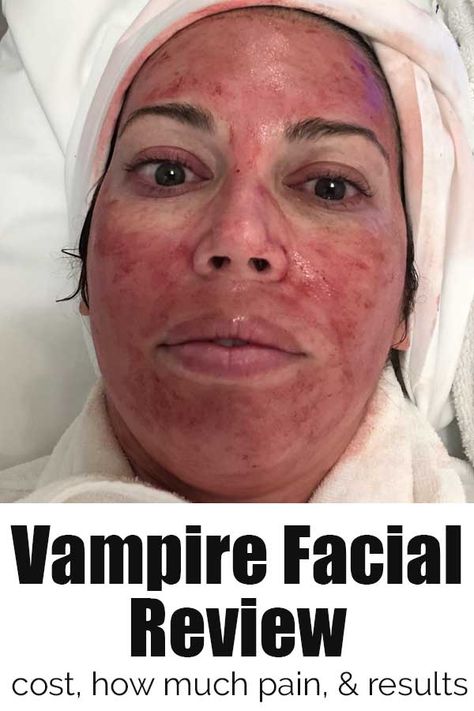 Vampire Facial Review: PRP Facial | The Happier Homemaker Vampire Facial Benefits, Prp Before And After, Prp Microneedling Before And After, Vampire Facial Before And After, Prp Face Before And After, Prp Facial, Plasma Facial, Facial Before And After, Microneedling With Prp