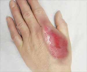 Do's and Don'ts of Natural Treatments for Burns Burns On Skin, Remedies For Burns, Home Remedies For Burns, Types Of Burns, 2nd Degree Burns, Burn Ointment, Burn Remedy, Facial Massage Techniques, Treat Burns