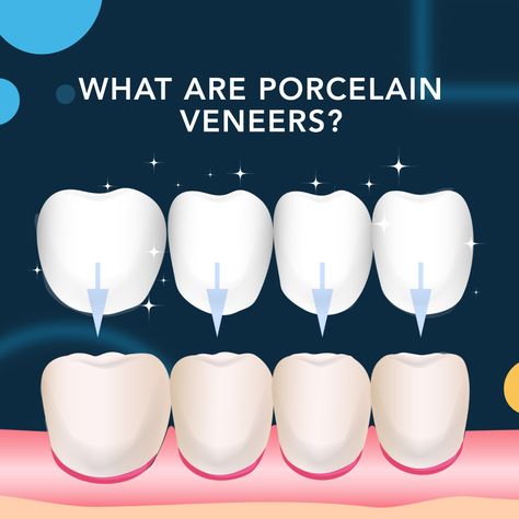 Dental veneers are a widely favored option in cosmetic dentistry as they offer a transformative solution for enhancing smiles by correcting chips, gaps, or uneven teeth. In this comprehensive guide, we will explore the numerous benefits of veneers, provide you with some of the lesser-known side effects, and discuss the essential maintenance practices that veneers require.