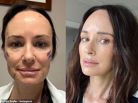 Aging Gracefully Hair, Facelift Recovery, Eye Lift Surgery, Catt Sadler, Speaking The Truth, Botox Lips, Face Lift Surgery, Facial Fillers, Facial Contouring