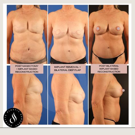 Implants After Mastectomy, Diep Flap Reconstruction, Implant Removal, Mastectomy Reconstruction, Breast Reconstruction, Lower Abdomen, Plastic Surgery, Surgery, Brave