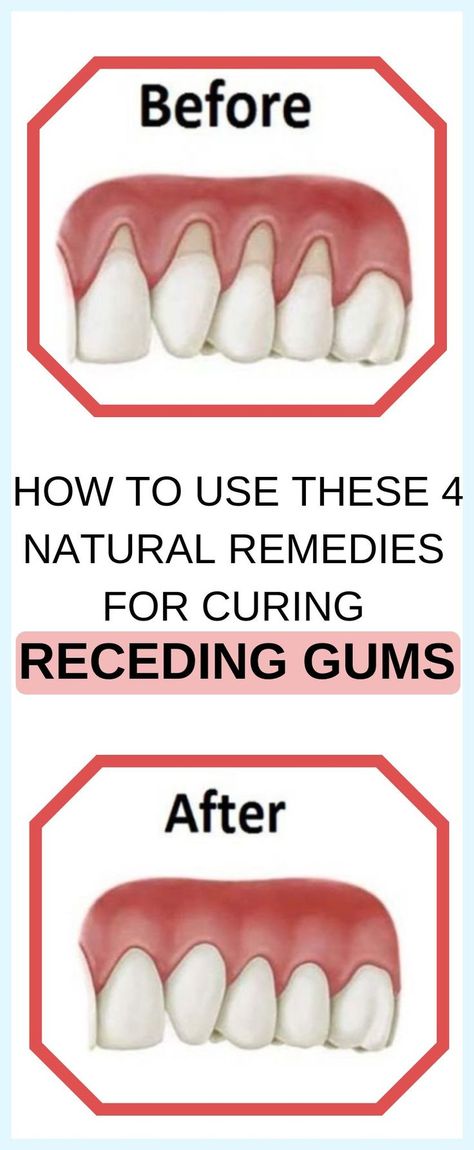 7 Natural Ways To Treat Receding Gums Teeth Health, Green Food, Oral Care Routine, Receding Gums, Gum Care, Gum Health, Oral Health Care, Tooth Decay, Healthy Teeth