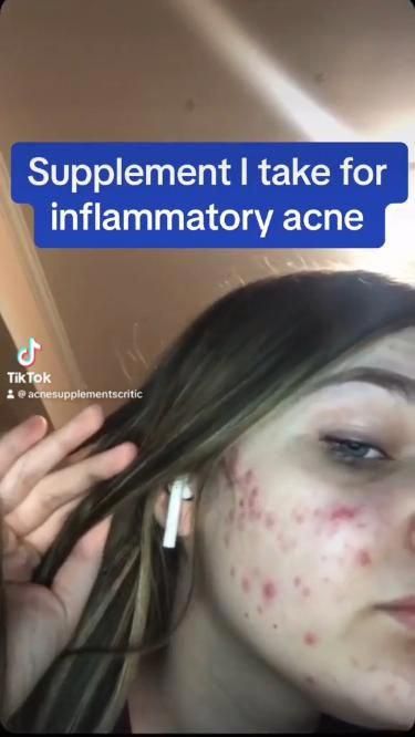 Clear Skin Vitamins, Vitamins For Clear Skin, Natural Remedies For Acne, Acne Supplements, Back Acne Remedies, Remedies For Acne, Inflammatory Acne, Skin Vitamins, Skin Supplements