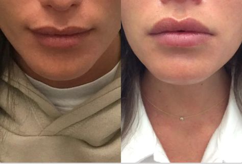 Lip Flip: How It Works, What It Costs, and What to Expect Botox Lip Flip, Botox Cost, Lip Flip, Botox Before And After, Muscles Of The Face, Botox Lips, Botox Cosmetic, Before And After Pics, Lip Augmentation