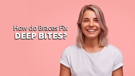 Most people may know that braces CAN fix deep bites—but most have no idea HOW it all works… In this article, we’re going to show you, in detail, how braces can fix a deep overbite. We’ll do it by discussing 3 specific ways that deep bites are corrected with braces. We will even show you before and after photos of actual patients who received deep bite correction. That way there’s no more mystery around braces and their function in fixing your bite and getting you to happier, healthier smile. Overbite Before And After, Adult Braces, Healthy Smile, Braces, That Way