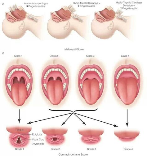 Malampati Respiratory Therapist Student, Anesthesia School, Nurse Anesthesia, Nurse Problems, Homemade Body Care, Human Body Organs, Nursing School Motivation, Critical Care Nursing, Respiratory Therapy