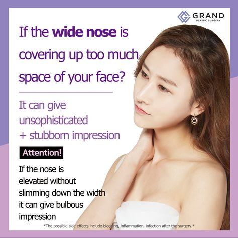 If you have a wide nasal bone just elevating the nose bridge without slimming down the width can make the nose look bulbous and big.  For free consultation Tel: (+82) 70-7119-1580 Mobile: (+82) 10-7156-6546 (Whatsapp, Line, Kakaotalk, Viber, iMessage) Email: grandps.en@gmail.com Facebook: facebook.com/grandplasticsurgery Webstie: eng.grandsurgery.com Pinterest : https://www.pinterest.co.kr/grandps_eng/ Tumblr: http://grandsurgery.tumblr.com Wide Nose, The Nose, Nose Bridge, How To Slim Down, Free Consultation, Plastic Surgery, Side Effects, Surgery, Bridge