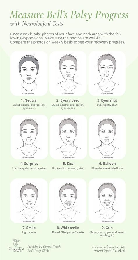 Facial Palsy Exercise, Bell’s Palsy Exercises, Bells Palsy Facial Exercises, Tens Unit Placement, Bell’s Palsy, Bf Ideas, Nerve Conduction Study, Combine Pictures, Bells Palsy