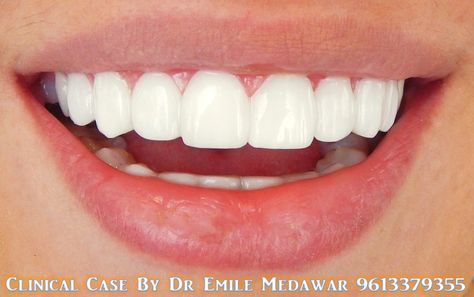 Hollywood smile Lebanon, Dr Emile Medawar 9613379355 www.emilemedawar.com #hollywoodsmile #lebanon #beirut #dentist #teethwhitening #veneers #dentalimplants #lumineers #emilemedawar #dentalclinic #gummysmile Teeth Aesthetic, Pretty Teeth, Corps Idéal, Veneers Teeth, Beautiful Teeth, Straight Teeth, Porcelain Veneers, Perfect Teeth, Nice Teeth