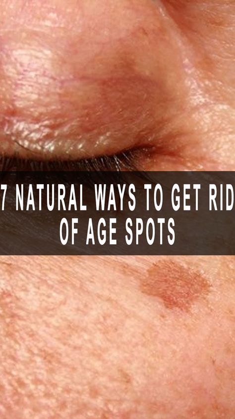 7 Natural Ways to Get Rid of Age Spots Get Rid Of Age Spots, Black Spots On Face, Get Rid Of Spots, Age Spot Removal, Natural Recipes, Onion Juice, Green Papaya, Spots On Face, Aloe Vera Plant