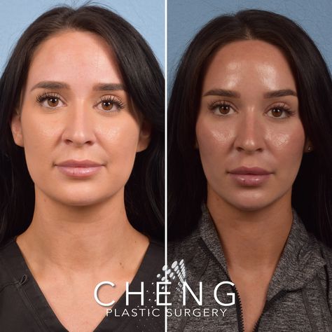 #botox #dysport #jawline #slimming #medspa #beforeandafter #aesthetic #cosmetics #plasticsurgeon Masseter Botox Injection Before And After, Facial Balancing Before And After, Jaw Botox Before After, Botox Jawline Before And After, Masseter Botox Before And After, Saggy Face, Face Plastic Surgery, Aesthetic Cosmetics, Botox Before And After