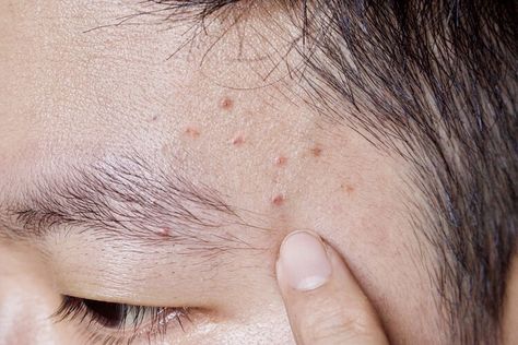 What Is Folliculitis, and How Do You Treat it? — Health Acne On Temples, Infected Hair Follicle, Pubic Hair Removal, Throbbing Headache, Acne Causes, Hair Removal Methods, Skin Condition, Hair Follicles, Daily Health Tips