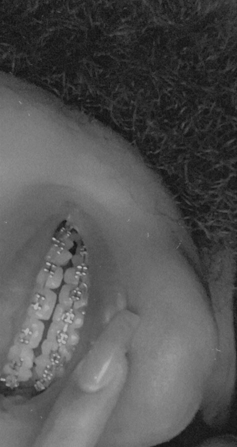 Brace face silver braces straight teeth black and whitr aesthetic Black Braces Aesthetic, Subliminal Photos, Braces Black Women, Braces Aesthetic, Silver Braces, Black Braces, Straight Smile, Cute Braces, Brace Face