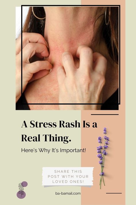 Have you ever got a sudden and inexplicable allergic skin reaction when you were amid an extremely challenging and stressful situation (or right after one)? If so, you might have not been allergic at all, and what you had really experienced was a stress rash. Yes, it’s true, a stressful day can truly make some people break out in hives anywhere in your body, and distinguishing this rash from an allergic reaction or a series of bug bites can be very difficult. Allergic Reaction Rash Remedies, Rashes On Skin, Allergy Hives, Allergic Reaction Rash, Home Remedies For Rashes, Hives Remedies, Neck Rash, Face Breaking Out, Rash On Face