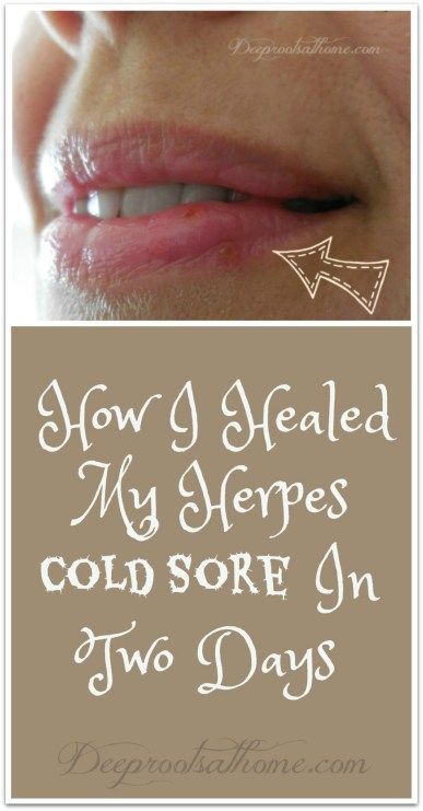 This resulted in the cold sore drying up within the first 18 hours! #essentialoils #naturalliving #coldsoreremedy Natural Cold Sore Remedy, I Healed, Cold Sores, Canker Sore, Cold Sores Remedies, Natural Cold Remedies, Cold Home Remedies, Cold Sore, Cold Remedies