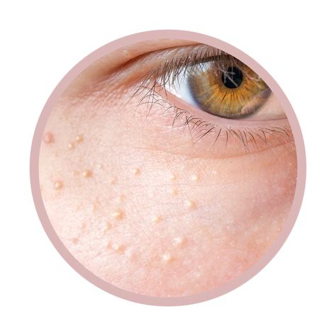 How to Get Rid of Milia, Those Pesky, Unpoppable White Bumps | Allure White Bumps On Skin, White Bumps On Face, Bumps On Face, Old Faces, Skin Conditions, Keratin, Bump, Home Remedies, Medical