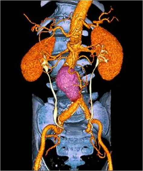 CT scan shows an abdominal aortic aneurysm above the aortoiliac junction Fitness Foods, Med Tech, Ct Scan, Critical Care, Radiology, Paramedic, The Human Body, Genetic, Reason Why