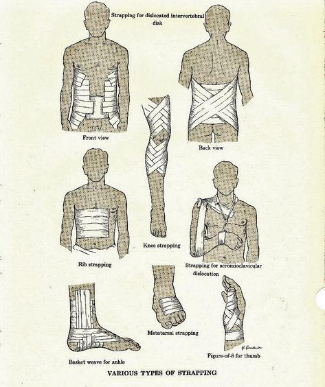 "Vintage Medical Anatomy Dictionary Strapping Illustration \"Dorland's Illustrated Medical Dictionary\" published in 1974 - VARIOUS TYPES OF STRAPPING This is perfect to frame or for collage and art projects. It will be shipped in a bend proof mailer. Enjoy and be creative! Size: 6 1/2\" x 10\" When possible, I do combine shipping for an order of multiple items, see all my other listings here... https://www.etsy.com/shop/PaperSymphony Thank you for shopping at Paper Symphony." Posture Reference Drawing, Cartoon Body Types, Human Anatomy Vintage, Anatomy Vintage, Vintage Anatomy, Medical Dictionary, Medical Anatomy, Vintage Medical, Anatomy Art