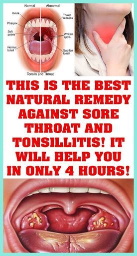 Swollen Tonsils, Sore Throat Remedies, Throat Remedies, Canker Sore, Cold Sore, Beauty Remedies, Natural Remedy, Sore Throat, Natural Health Remedies