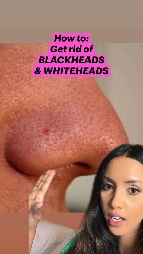 #getridofblackheadsonnose Blackheads And Whiteheads, Bentuk Alis, Blackheads On Nose, Rid Of Blackheads, Serious Skin Care, Good Skin Tips, Skin Care Tutorial, Basic Skin Care Routine, Clear Skin Tips