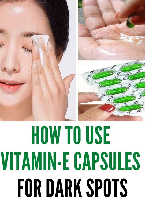 Vitamin E oil is derived from vitamin E, and you can directly apply it on your skin, can consume it, or even apply it on your hair. Many companies make vitamin E supplements and also products that contain vitamin E. So, let us have a look at some of the benefits of vitamin e capsules and uses. #darkspots #face #vitamine Beautiful Tips For Face, Skin Care With Vitamin E Capsule, Use Of Vitamin E Capsule For Face, Vitamin E Benefits For Skin, Uses Of Vitamin E Capsules For Skin, Vitamin E Capsules For Face How To Use Vitamin E Capsules For Face, How To Use Vitamin E Capsules For Face, Vitamin E Capsules For Hair, Vitamine E Capsules