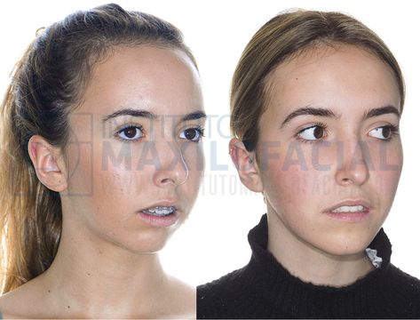 Orthognathic Surgery Before And After, Orthognathic Surgery, Clean Skin Face, Facial Bones, Facial Anatomy, Jaw Surgery, Geometric Wolf, Facial Fillers, Ancient Chinese Dress