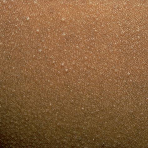 Keratosis pilaris , usually on the upper arms and legs," says Debra Jaliman, MD, author of Skin Rules. Because the skin doesn't exfoliate normally, the excess keratin blocks the pores, which results in tiny bumps. Treat using a sonic cleansing brush (like the Clarisonic Mia 2, $149, clarisonic.com), which gently speeds up the exfoliation process and moisturizes with lactic or salicylic acid (since dry skin tends to make the condition worse. Red Skin Spots, Brown Spots On Skin, Dry Skin Care Routine, Cream For Oily Skin, Skin Bumps, Dry Skin Remedies, Keratosis Pilaris, Face Scrub Homemade, Ingrown Hairs