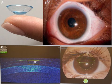 Eye, Published online: 31 January 2022; doi:10.1038/s41433-022-01942-6Assessment of long-term visual outcomes in aphakic children wearing scleral contact lenses Seventeen Eyes, Scleral Contact Lenses, Scleral Lenses, Eye Contact Lenses, Lenses Eye, Contact Lens, Emergency Room, School Of Medicine, Contact Lenses