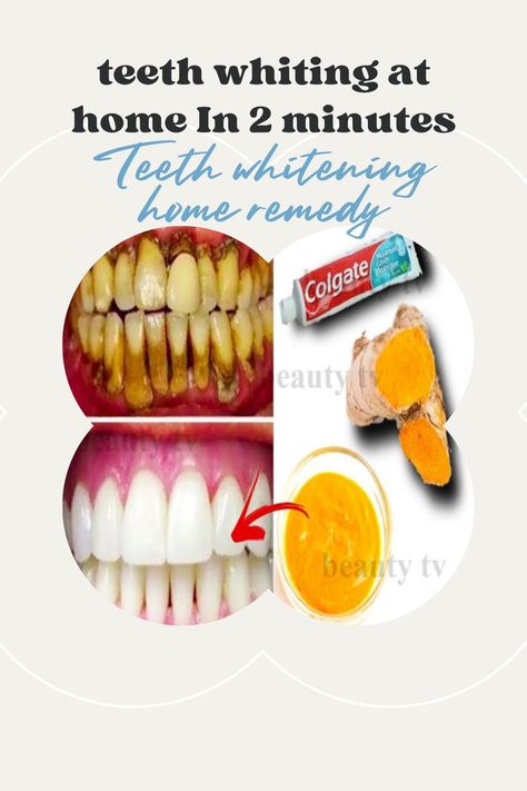 Teeth Whitner, White Teeth Tips, Teeth Tips, Natural Teeth Whitening Diy, Teeth Whiting At Home, Teeth Whitening Remedies, Teeth Whitening Diy, Beauty Hacks Skincare, Stained Teeth