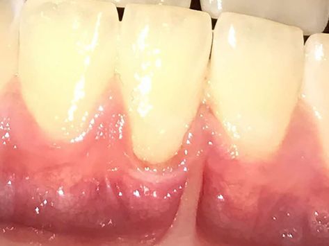 Reverse Receding Gums, Gum Graft, Grow Back Receding Gums, Gum Inflammation, Gum Recession, Healthy Gums, Teeth Health, Receding Gums, Dental Procedures