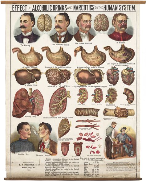 A spectacular 1910 chromolithographic poster illustrating the effects of alcohol and tobacco, issued just as the Temperance movement was nearing its apogee. Temperance Movement, Effects Of Alcohol, Antique Maps, Dark Ages, Vintage Love, American History, Metal Posters Design, Metal Posters, Metal Prints